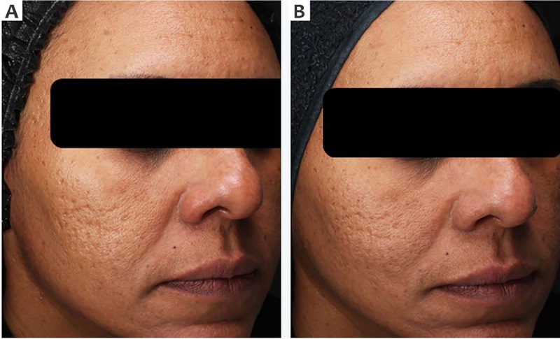 A - Imagens cl&iacute;nicas da lateral direita da face antes do tratamento
                            (D1). B - 40 dias ap&oacute;s o tratamento (D55) - Grupo experimental