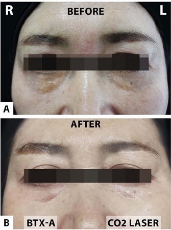 A - Antes do tratamento. B - Seguimento de 7 meses ap&oacute;s a aplica&ccedil;&atilde;o
                            de TXB-A intrad&eacute;rmica na &aacute;rea periorbital direita e laser de
                                CO2 na &aacute;rea periorbital esquerda.