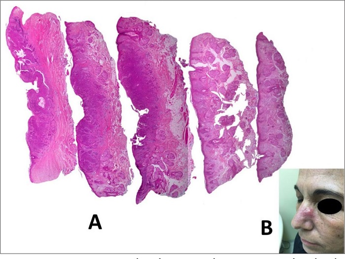 Como se pode observar claramente, o laudo do patologista estava
							correto: carcinoma basocelular (CBC) infiltrativo com margens livres
								(A). Por�m, um ano depois, a paciente desenvolveu uma
							tumora��o no mesmo local operado, sendo que a bi�psia revelou tratar-se
							de um CBC infiltrativo (B). Ou seja, a �nfima amostragem da
							cirurgia convencional n�o foi capaz de demonstrar o real comprometimento
							das margens, gerando um falso-negativo. Detalhe importante tamb�m: a
							disposi��o dos cortes nos sugere que a amostragem foi do tipo
								&ldquo;bread loaf - corte p�o&rdquo;, e as bordas cir�rgicas
							n�o est�o pintadas, mas deveriam estar. Colora��o Hematoxilina &
							eosina 20x