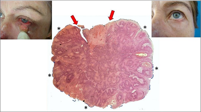 Paciente tinha um tumor exof�tico na p�lpebra inferior. O
								dermatologista fez um shaving na base da les�o e colocou o esp�cime
								no formol. O histot�cnico recebeu o material esf�rico e pintou
								equivocadamente toda a superf�cie (asteriscos). O �nico local que
								deveria ser pintado, para marcar a borda cir�rgica, seria entre as
								setas vermelhas. O patologista laudou como "margem
								coincidente". Acompanhamento por 13 anos sem recidiva.
								Falso-positivo por artefato de t�cnica. Colora��o Hematoxilina &
								eosina 20x