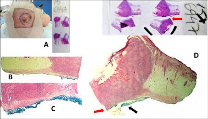 Paciente com um carcinoma espinocelular (CEC) clinicamente n�o
								aderente ao peri�steo foi submetido � cirurgia convencional com
								margens de seguran�a e enxerto imediato. O laudo do exame
								anatomopatol�gico foi de margem profunda comprometida, depois do
								exame das duas l�minas aqui expostas. Na l�mina A,
								observem que a tinta n�o encosta no tumor (B e
									C). Na outra l�mina, a tinta encosta no tumor
								claramente (D) (setas vermelhas). Por�m, houve um
								desprendimento da superf�cie mais profunda, a partir da clivagem da
								pe�a. Esta camada deveria estar colocada abaixo do tumor, mas se
								retraiu depois da clivagem da pe�a. O t�cnico informou que ele
								pintou a pe�a depois da clivagem e n�o antes, contaminando assim a
								por��o profunda do tumor com a tinta, por causa da retra��o da
								camada mais profunda, esta, sim, a �nica que realmente representa a
								borda cir�rgica e que deveria estar pintada (seta preta).
								Acompanhamento do paciente por mais de sete anos sem recidiva.
								Falso-positivo por artefato de t�cnica. O patologista concordou com
								os argumentos apresentados e, depois, modificou o laudo. Eu mesmo
								operei o paciente e conferi o histopatol�gico. Colora��o
								Hematoxilina & eosina 20x