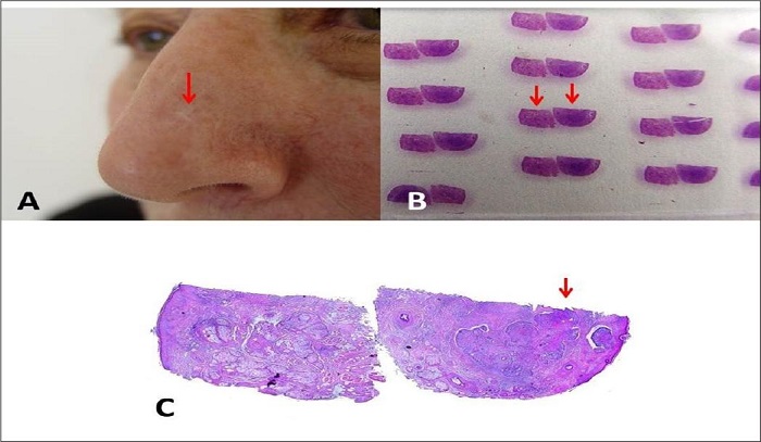 Paciente foi encaminhada para fazer cirurgia microgr�fica por
								laudo de margem comprometida. Clinicamente, observamos apenas uma
								pequena cicatriz (seta vermelha), sem sinais cl�nicos ou
								dermatosc�picos sugestivos de persist�ncia de tumor
								(A). O exame direto dos cortes na l�mina mostra
								claramente superf�cies retas, t�picas de clivagem do esp�cime (setas
								vermelhas) (B). O exame dos cortes (C)
								mostra aus�ncia de tintas marcando a borda cir�rgica, sendo que o
								tumor toca a superf�cie reta de um dos fragmentos, que t�m sua
								correspond�ncia na outra superf�cie reta do outro fragmento, este,
								sem tumor. Levei os cortes e o laudo para o patologista que se
								desculpou pelo equ�voco. Paciente nunca recidivou depois de mais de
								oito anos de observa��o. Colora��o Hematoxilina & eosina
								20x