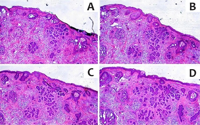 Sequ�ncia de cortes histol�gicos do m�todo de Munique, com
								intervalo de 50 MICRA entre os cortes. O CBC se aproxima da borda
								cir�rgica ficando a poucas micra da borda cir�rgica (1 e 2). Nos
								cortes 3 e 4, a epiderme fecha a borda cir�rgica, e o tumor continua
								a n�o tocar a epiderme, pois sua origem n�o � neste ponto. Muitos
								patologistas n�o habituados a esse tipo de an�lise laudariam
								"margem comprometida" ou "margens ex�guas",
								ficando o cirurgi�o com a responsabilidade de interpretar o laudo.
								Desta forma, o tipo de vis�o do patologista pode representar um
								falso-positivo. Colora��o Hematoxilina & eosina 20x