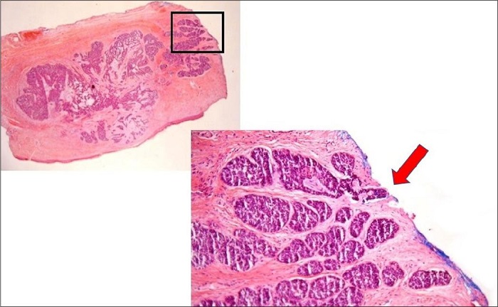 Margem coincidente. Poucos s�o os patologistas que laudam esta
								situa��o como margem coincidente (seta vermelha). O tumor toca a
								borda cir�rgica claramente, mas apresenta borda arredondada, isto �,
								d� a impress�o de que pode ter parado exatamente ali. Se esta
								imagem, e sua interpreta��o como margem coincidente, representa a
								realidade, n�o h� tumor residual no paciente, sendo outra causa de
								falso-positivo. Por�m, realmente, trata-se de um dilema para
								patologistas ou cirurgi�es, pois o tumor toca a borda cir�rgica e
								n�o temos como comprovar que ele acabou exatamente neste ponto. No
								entanto, observe que o carcinoma basocelular apresenta predomin�ncia
								de crescimento expansivo, o que aumenta a chance da interpreta��o de
								margem coincidente e, por consequ�ncia, a chance de representar um
								falso-positivo. Caso o tipo histol�gico predominante fosse
								infiltrativo, essa interpreta��o seria mais arriscada. Colora��o
								Hematoxilina & eosina 20x