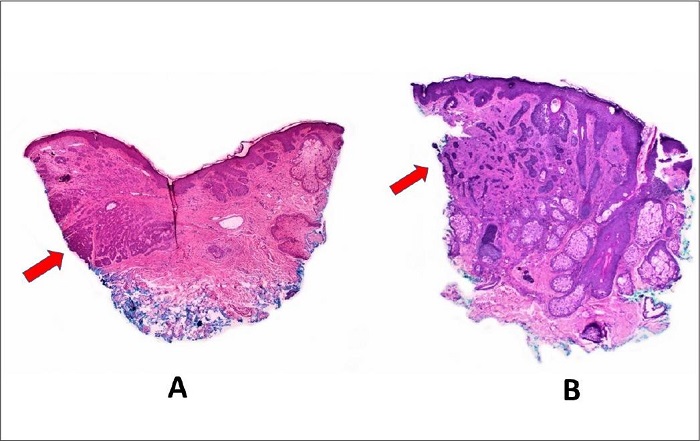 Exemplos t�picos de margens comprometidas. Em A, a massa
							tumoral est� como cortada ao longo da sua extens�o, apresentando-se reta
							por uma boa extens�o da borda cir�rgica, n�o dando impress�o de ser
							acometimento focal. Em B, o CBC � bastante infiltrativo,
							tocando a borda cir�rgica com pequenos fragmentos tumorais fazendo
							protrus�o na mesma (seta). Colora��o Hematoxilina & eosina
							20x
