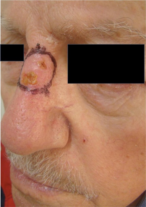 Carcinoma basocelular infiltrativo no dorso nasal