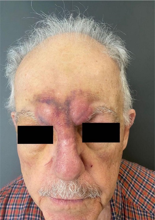 Nodula��es na regi�o frontal que correspondem �s les�es cl�nicas dos
							pseudoaneurismas de art�rias supratrocleares