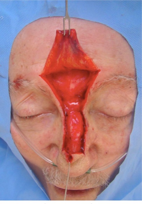 Defeito cir�rgico final. Reconstru��o com retalho de avan�o na regi�o
							glabelar