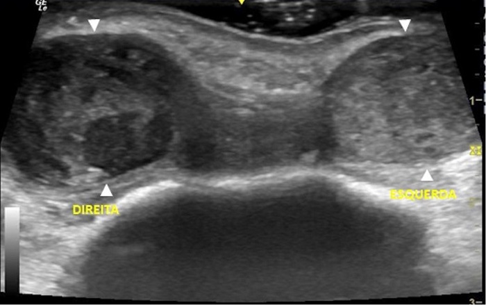 Corte transversal de regi�o frontal: hematomas direito e esquerdo
							delimitados pelas cabe�as de setas brancas