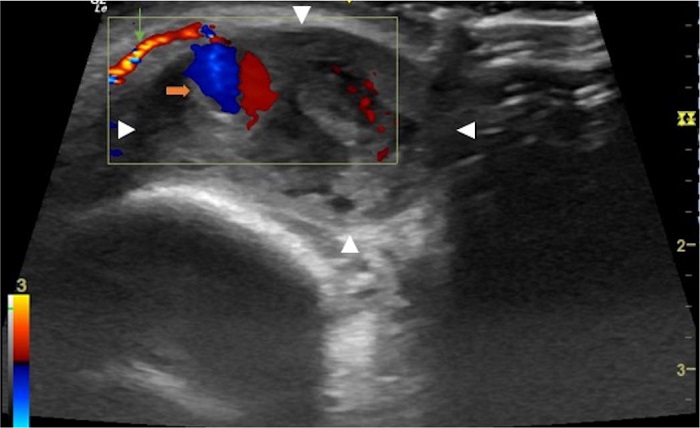 Corte longitudinal da regi�o frontal direita: hematoma frontal
							direito delimitado pelas cabe�as de setas brancas, art�ria supratroclear
							direita indicada pela seta verde e o pseudoaneurisma indicado pela seta
							laranja