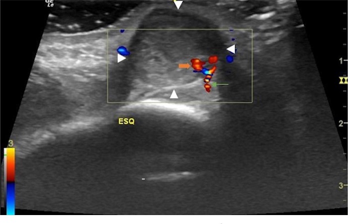 Corte transversal da regi�o frontal esquerda: hematoma frontal
							esquerdo delimitado pelas cabe�as de setas brancas, art�ria
							supratroclear esquerda indicada pela seta verde e o pseudoaneurisma
							indicado pela seta laranja