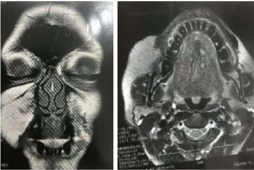 Resson�ncia magn�tica da face. Aumento assim�trico do tecido
                            gorduroso subcut�neo da hemiface direita, em proje��o da regi�o
                            maxilar