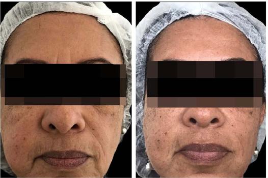 Foto comparativa de antes do tratamento (esquerda) e ap�s o
                            tratamento (direita). Melhora evidente de gordura da hemiface
                            direita