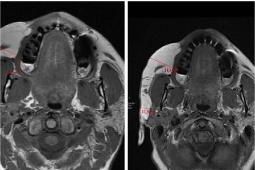 Compara��o da resson�ncia magn�tica da face realizada antes do
                            tratamento (esquerda) e ap�s tratamento (direita). Redu��o da espessura
                            do enxerto na sua por��o anterior, al�m de distribui��o mais sim�trica
                            do mesmo na hemiface direita. Sinais de preenchimento com �cido
                            hialur�nico no subcut�neo da regi�o anterior e lateral da face
                            bilateralmente