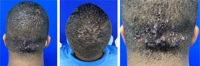 Pr�-tratamento com laser de Er:YAG: presen�a de
                            papu-lop�stulas foliculares eritematosas, p�pulas fibr�ticas
                            confluentes, n�dulos e politriquia na regi�o occipital e vertex