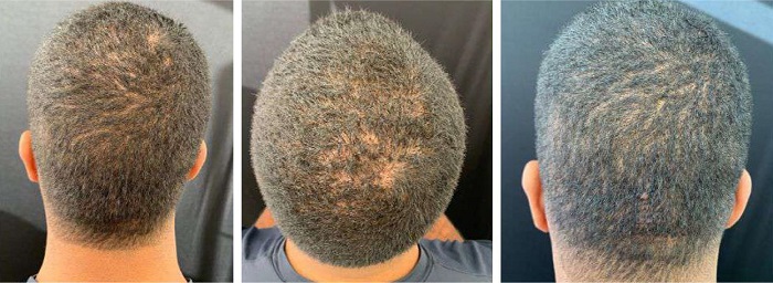 P�s-tratamento com laser de Er:YAG: melhora das
                            papulop�stulas e presen�a de raras �reas com p�pulas fibr�ticas.