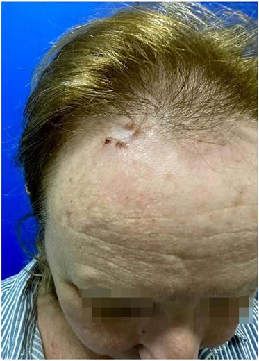 Placa de bordas peroladas e centro levemente eritematoso e atr�fico
                            na fronte, mais especificamente no tr�quio