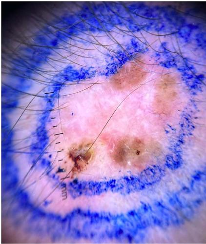 Dermatoscopia: vasos arboriformes, ninhos de pigmento e
                            eros�es