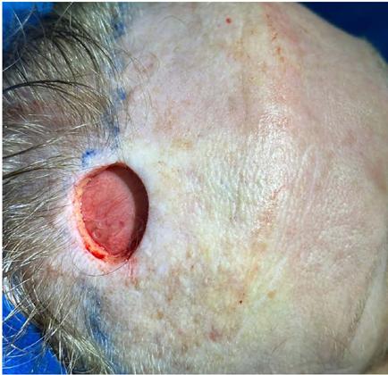 Ex�rese do tumor associada � frontoplastia com incis�o
                            pr�-capilar