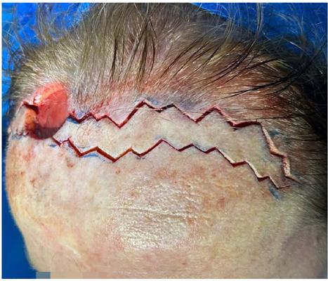 Marca��o da frontoplastia, com o objetivo de preservar os
                                fol�culos pilosos e remover 3 cm de faixa de pele/subcut�neo