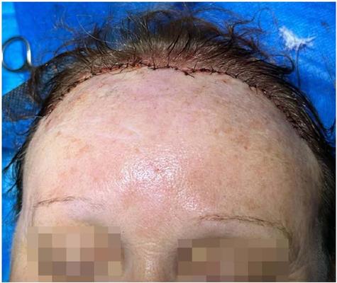 Fechamento da ferida suturada por planos, com pontos internos
                                utilizando Vicryl 4-0 e sutura externa com nylon 5-0