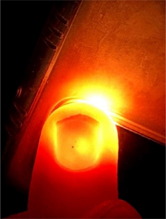 Transilumina��o ungueal