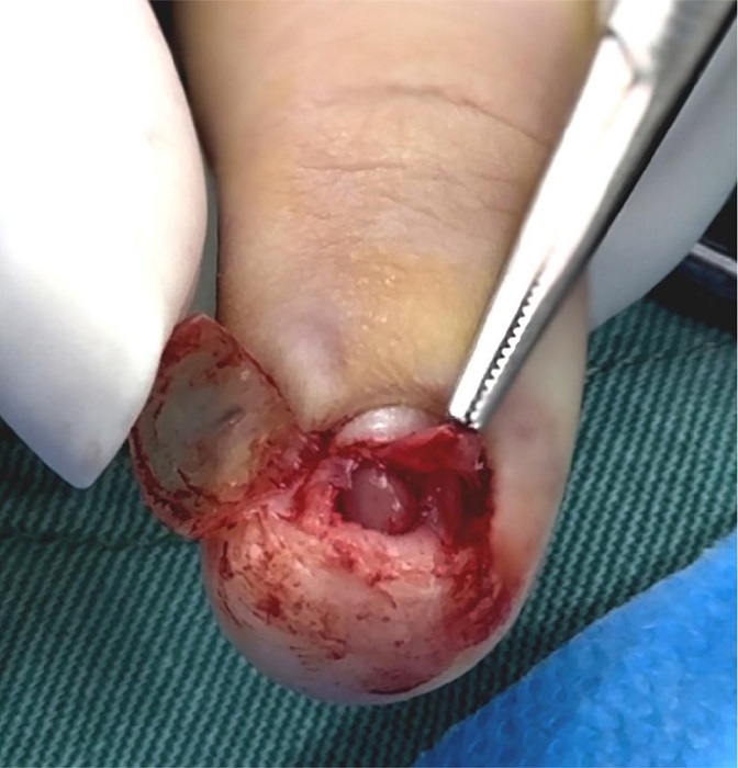 Visualiza��o de tumor gl�mico em intraoperat�rio