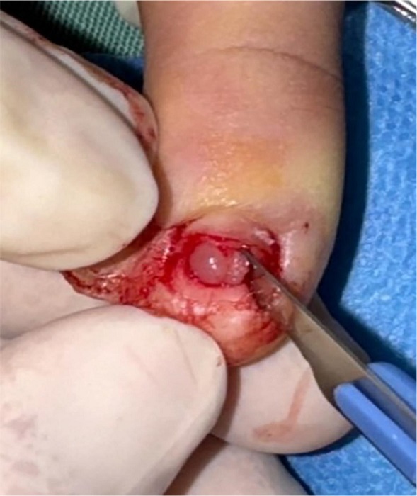 Visualiza��o de tumor gl�mico em intraoperat�rio