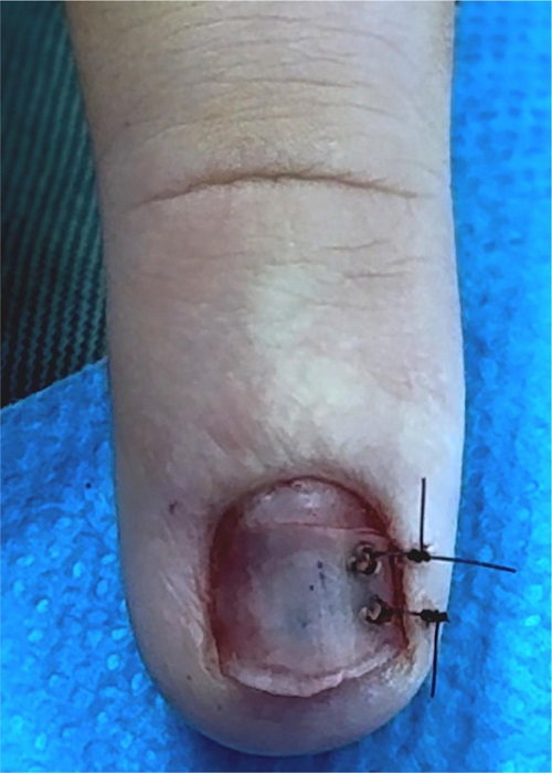 P�s-operat�rio imediato