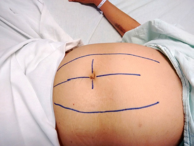 Se marcan los bordes de los rectos abdominales y la cicatriz umbilical para determinar el mejor sitio de colocaci&oacute;n