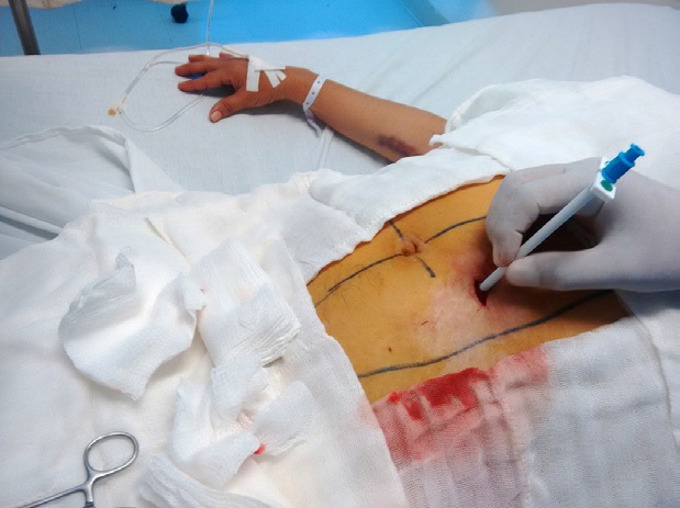 Colocaci&oacute;n del introductor romo hacia cavidad peritoneal. 