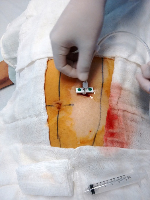 Introducci&oacute;n del cat&eacute;ter a trav&eacute;s de la f&eacute;rula pl&aacute;stica del introductor