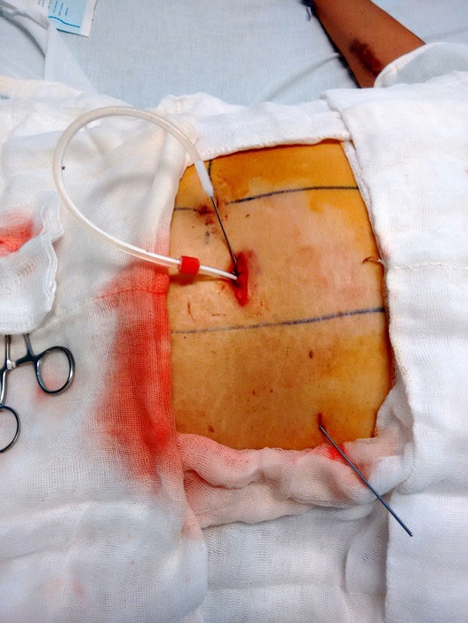 Salida del cat&eacute;ter en la porci&oacute;n lateral de la pared abdominal.