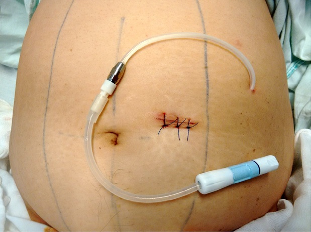 Cat&eacute;ter al t&eacute;rmino de la colocaci&oacute;n percut&aacute;nea