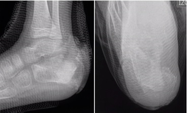 Radiograf&iacute;a en paciente de 5 a&ntilde;os con osteomielitis de calc&aacute;neo polimicrobiana. Se aprecia aumento de la opacidad &oacute;sea acompa&ntilde;ada de resorci&oacute;n en la regi&oacute;n posterior del calc&aacute;neo, con edema de tejidos blandos.