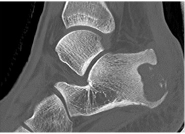 Corte sagital de una TAC en una paciente de 15 a&ntilde;os con osteomielitis de calc&aacute;neo. Se observa una lesi&oacute;n l&iacute;tica extensa en el aspecto posterolateral, con secuestros en su interior, y otro foco de lisis en la parte anterior del calc&aacute;neo.