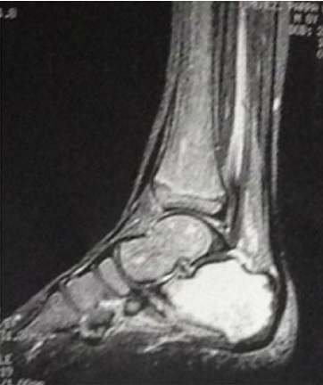 Resonancia del pie izquierdo del paciente de 8 a&ntilde;os. Se nota un incremento en la intensidad en la secuencia de supresi&oacute;n de grasa en el calc&aacute;neo, compatible con cambios producidos por un proceso inflamatorio o infeccioso en este hueso.