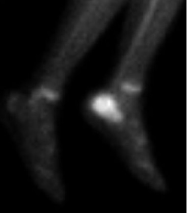 Gammagraf&iacute;a &oacute;sea en fase tard&iacute;a del paciente anterior con osteomielitis de calcaneo izquierdo. Se observa aumento en la captaci&oacute;n &oacute;sea del radiotrazador en el calc&aacute;neo con compromiso infeccioso o inflamatorio