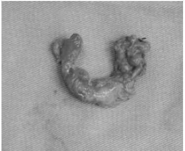 sp&eacute;cimen producto de apendicectom&iacute;a que mide 7 cm x 1 cm x 1 cm en el estudio anatomopatol&oacute;gico, recubierto por una serosa despulida de color pardo oscuro. La histoarquitectura evidencia proceso inflamatorio agudo severo de distribuci&oacute;n transmural y extensa necrosis, sin malignidad. 