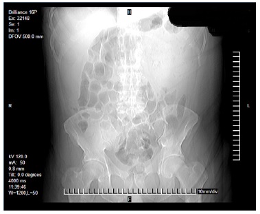 Imagen que muestra el aumento de la densidad del cuadrante superior izquierdo, distensión y edema interesa en el resto de los cuadrantes. 