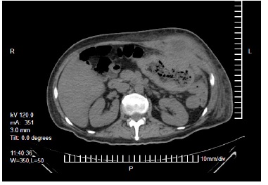Engrosamiento de la pared del colon transverso, con pérdida de la interfase hacia la pared abdominal y colección líquida a nivel de la unión del recto anterior del abdomen y los músculos oblicuos.