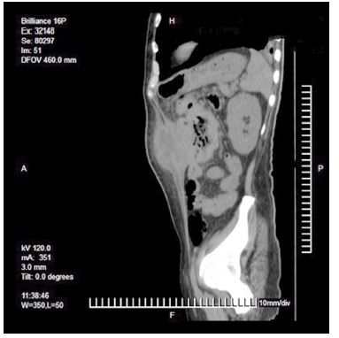  Corte sagital donde se observa la tumoración del colon transverso y su invasión a la pared abdominal. 