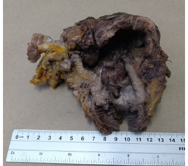 La pieza macroscópica corresponde a un segmento de intestino grueso el cual presenta solución de la continuidad de su pared donde se observa una gran perforación con bordes irregulares y engrosamiento de la misma al corte la mucosa sobre la lesión es de aspecto nodular exofítico que ocupa parte de la luz intestinal y afecta concéntricamente.