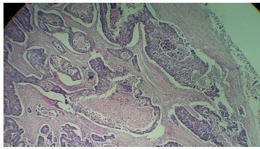 Los cortes histológicos teñidos con tinción de rutina H&E muestran una proliferación difusa de elementos glandulares atípicos con anaplasia celular marcada y presencia de necrosis sucia intraluminal. 