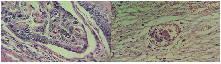 Izquierda: el corte histológico muestra la anaplasia celular marcada y mitosis atípicas presentes. Derecha: se identifica invasión vascular por las células neoplásicas.