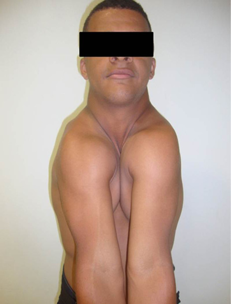 Hiperfuncionalidad de la articulación del hombro al aproximarlos hacia línea media anterior del tórax.