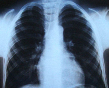 Radiografía de tórax donde se observa hipoplasia clavicular y tórax en forma de campana.