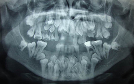 Radiografía panorámica en donde se revela la presencia de múltiples dientes supernumerarios
