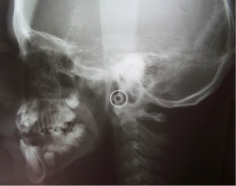 Radiografía lateral de cráneo en donde se observan huesos wormianos lamdoideos.