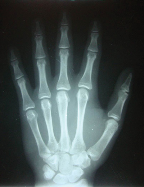 Radiografía carpal sin alteraciones.